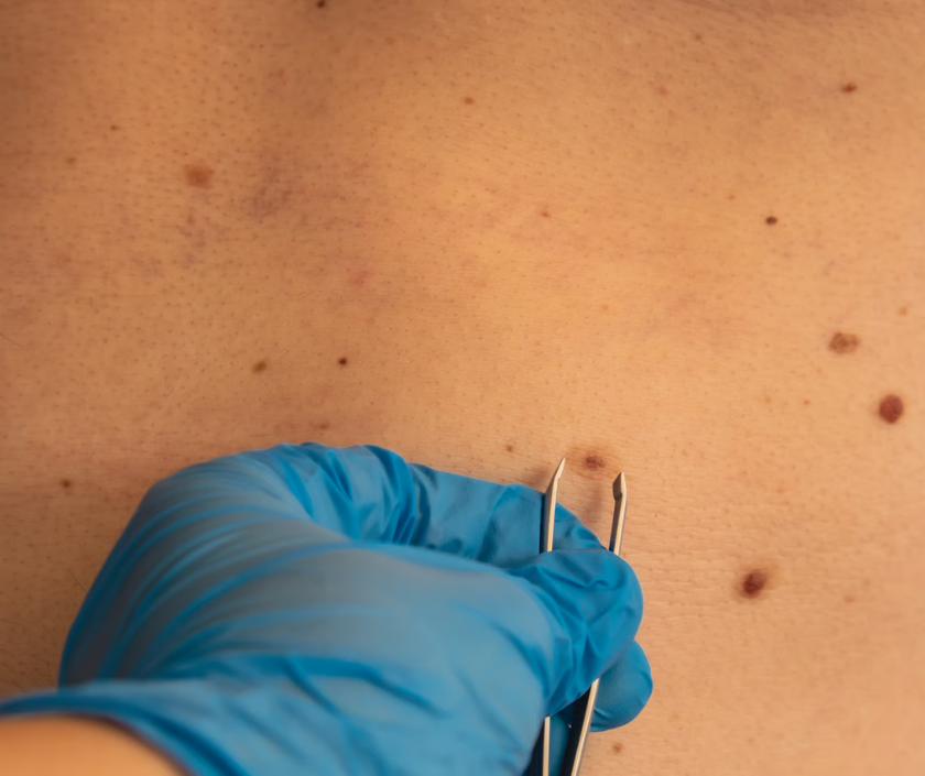 Skin tags - soft fleshy hanging skin growths commonly found on neck and underarms