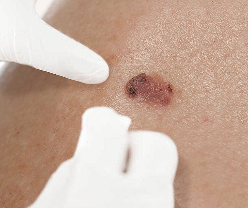 Squamous cell carcinoma - rough scaly red skin cancer lesion on sun-damaged skin