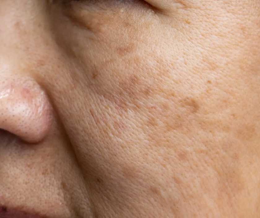 Tan and uneven skin tone - patchy sun-tanned complexion with discoloration on exposed areas