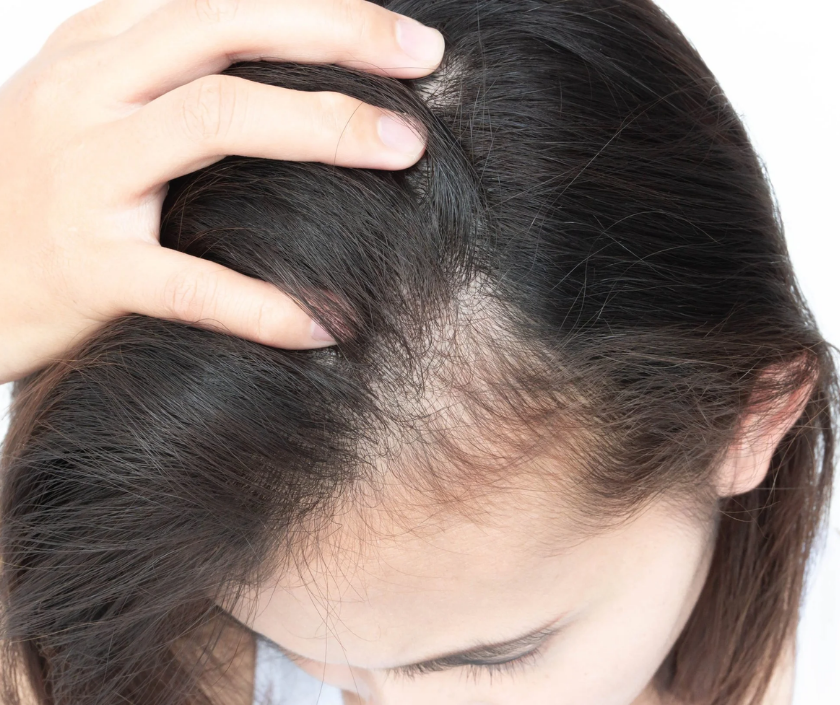 Telogen effluvium - diffuse stress-related hair shedding and overall thinning of hair