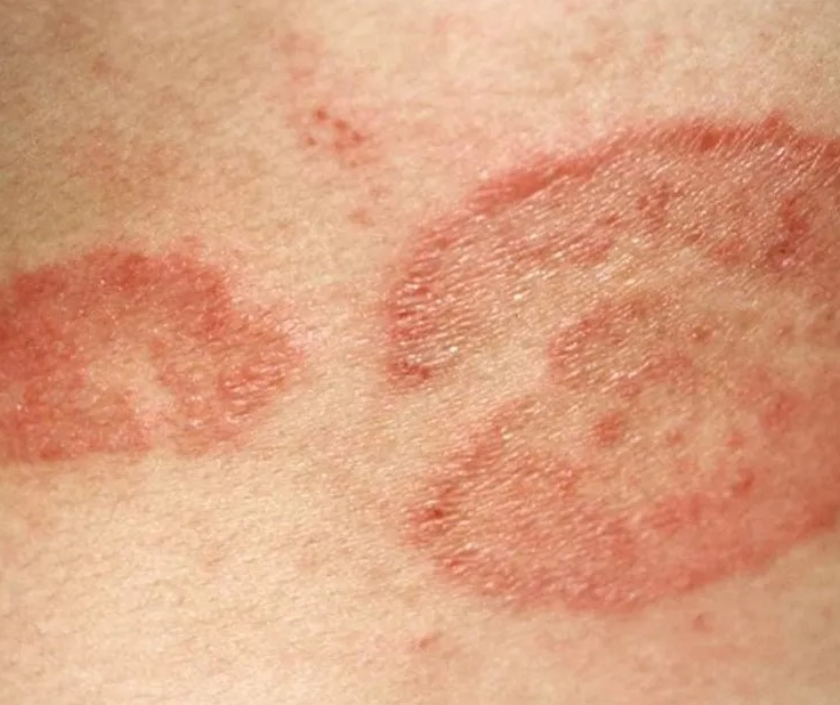 Tinea or ringworm - circular red scaly fungal rash with clear center on the skin