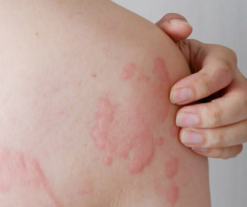 Urticaria or hives - itchy raised pink welts of allergic skin reaction