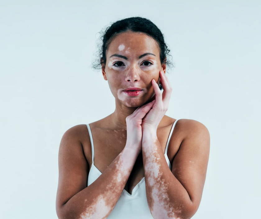 Vitiligo - smooth depigmented white skin patches from loss of pigment-producing cells