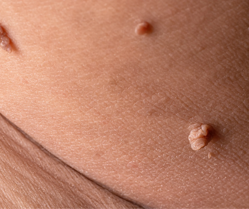 Warts - rough HPV-caused skin growths commonly found on hands and feet