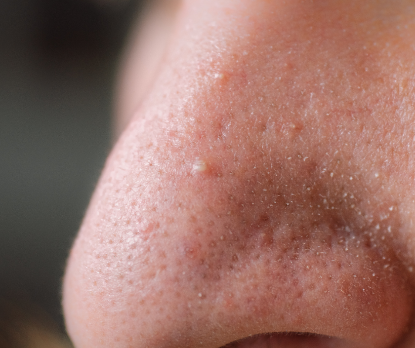 Whiteheads on face - small closed clogged pores forming tiny white bumps (closed comedones)