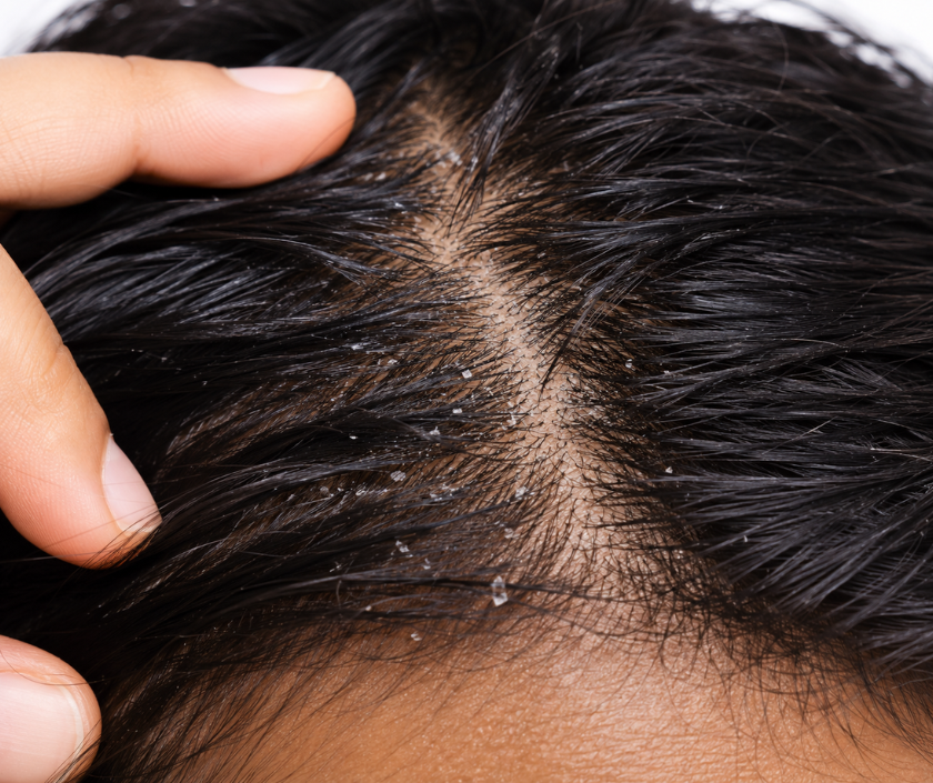 Dandruff Management