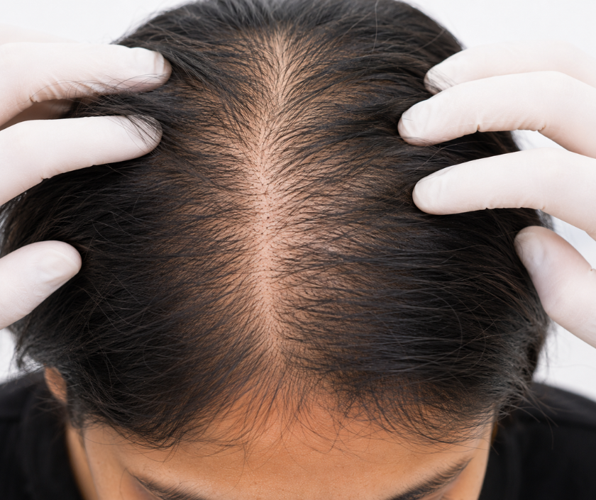 Diffuse Hair Loss Treatment