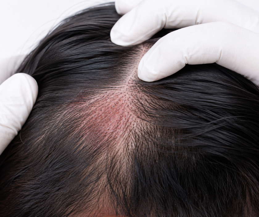 Scalp Infection Management