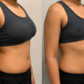 How Chest Reduction for Trans Men Can Support Gender Affirmation Goals