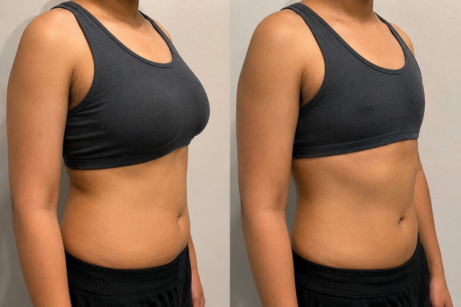 chest reduction for trans men