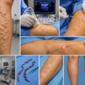 Dialysis Mate Vein Surgery: AV Fistula Surgery Guide