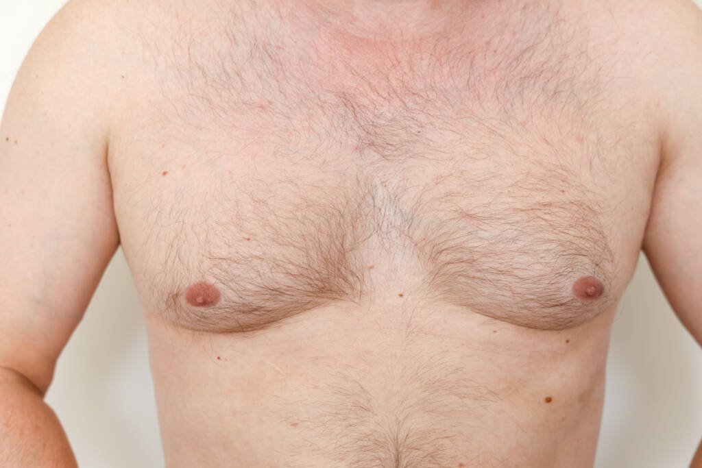 gynecomastia