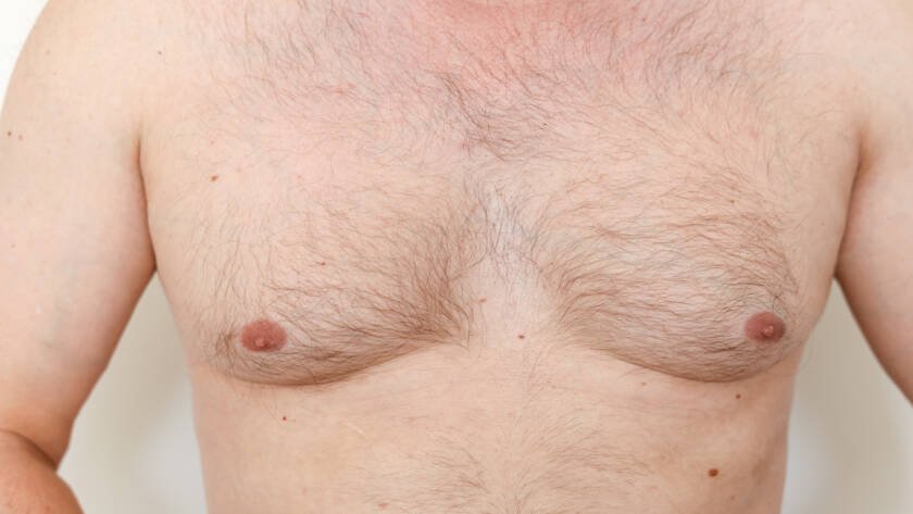 gynecomastia