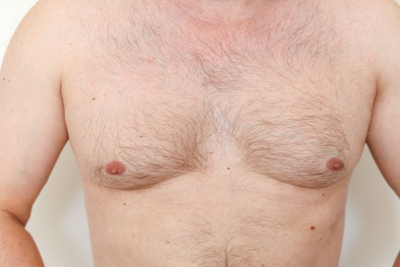 gynecomastia