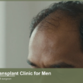 Best Hair Transplant Clinic for Men Near Me: How to Choose
