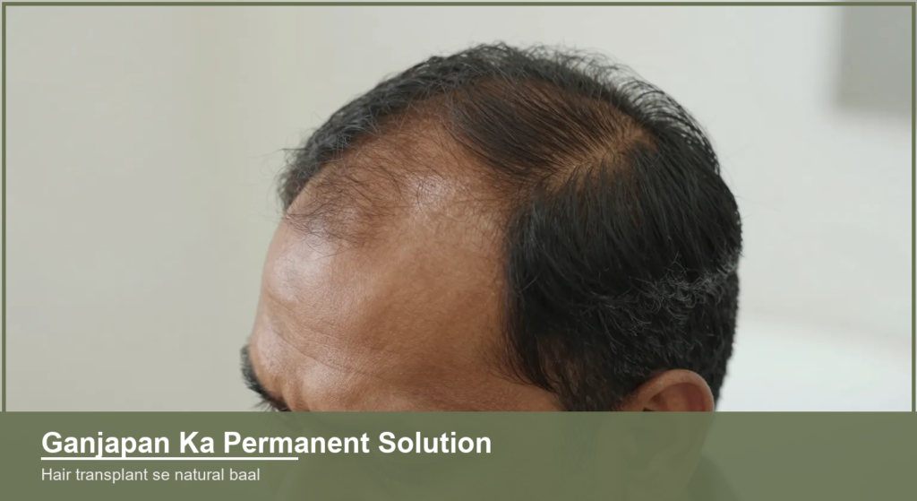 Indian man's scalp and receding hairline showing hair loss before a hair transplant procedure