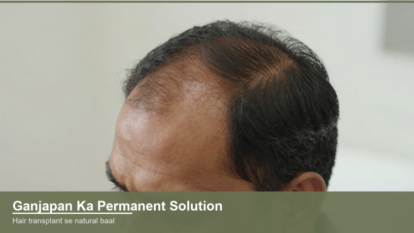 Indian man's scalp and receding hairline showing hair loss before a hair transplant procedure