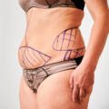 Advanced Liposuction for Tummy Fat Removal – A Complete Guide