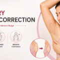 Axillary Breast Correction in Surat: Fixing the Underarm Bulge