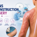 Burns Reconstruction Surgery: Rebuilding Movement and Confidence