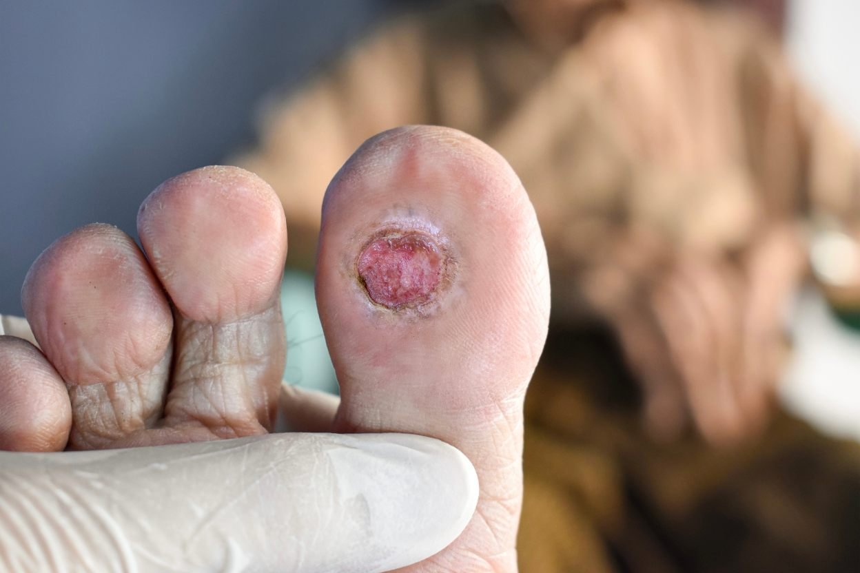 Diabetic foot ulcer assessment during Observership in Diabetic Foot Surgery at Elegance Clinic, Surat