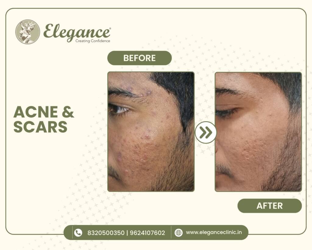 Acne-Scar-Reduction