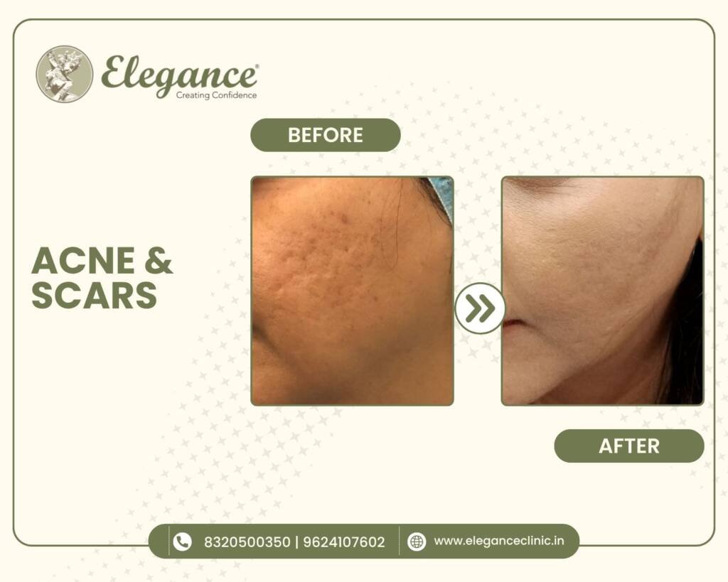 Acne-Scar-Treatment