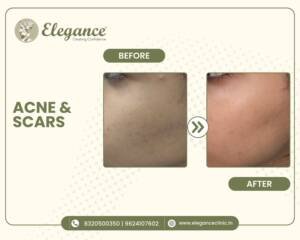 Acne-Treatment