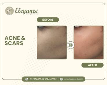 Acne-Treatment