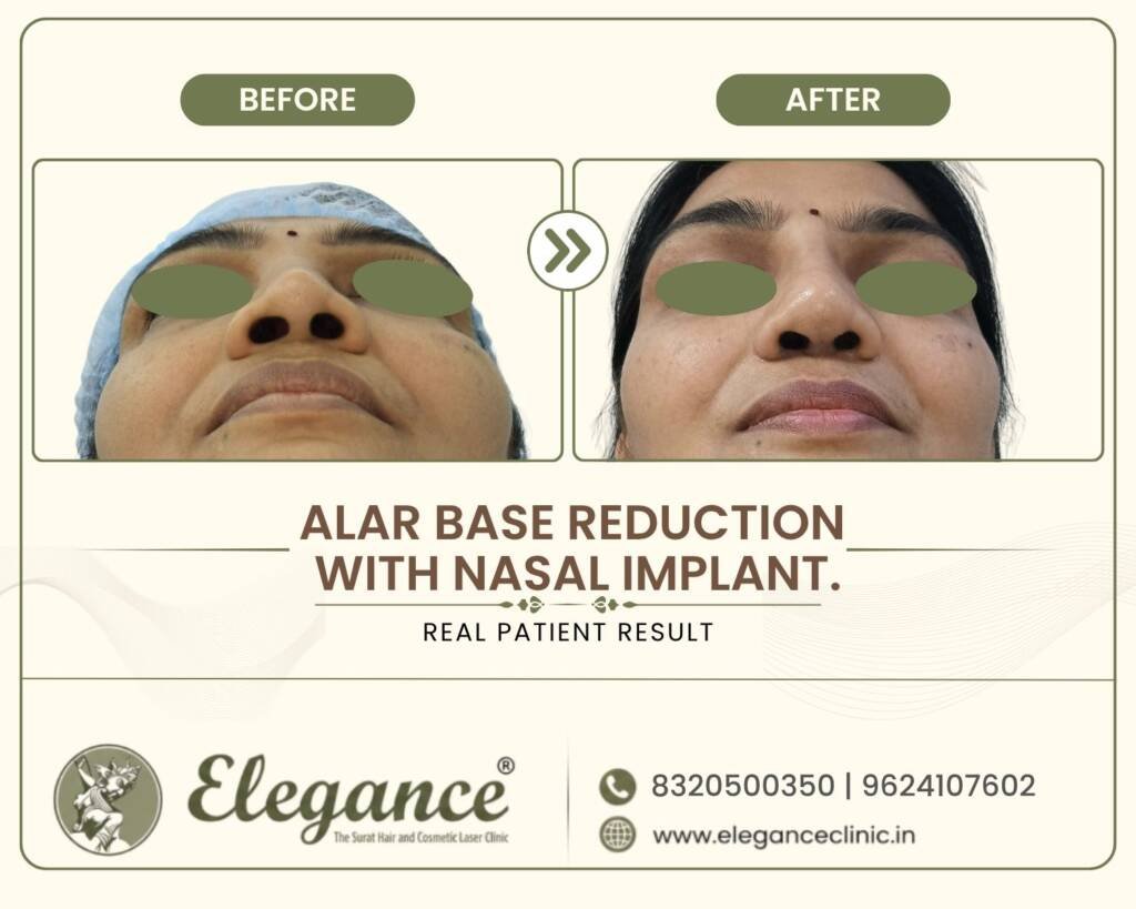 Alar-Base-Reduction