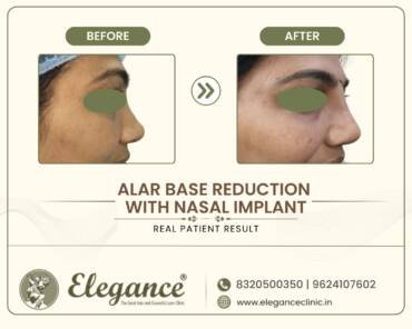 Alar-Base-Reduction-Nasal-Implant