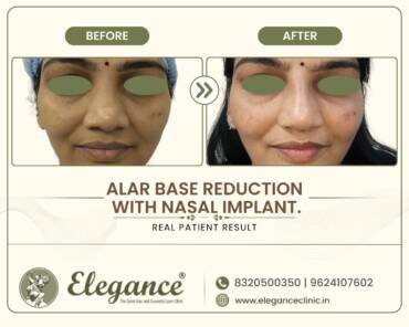 Alar-Base-Reduction-Nasal-Implant-Front-View