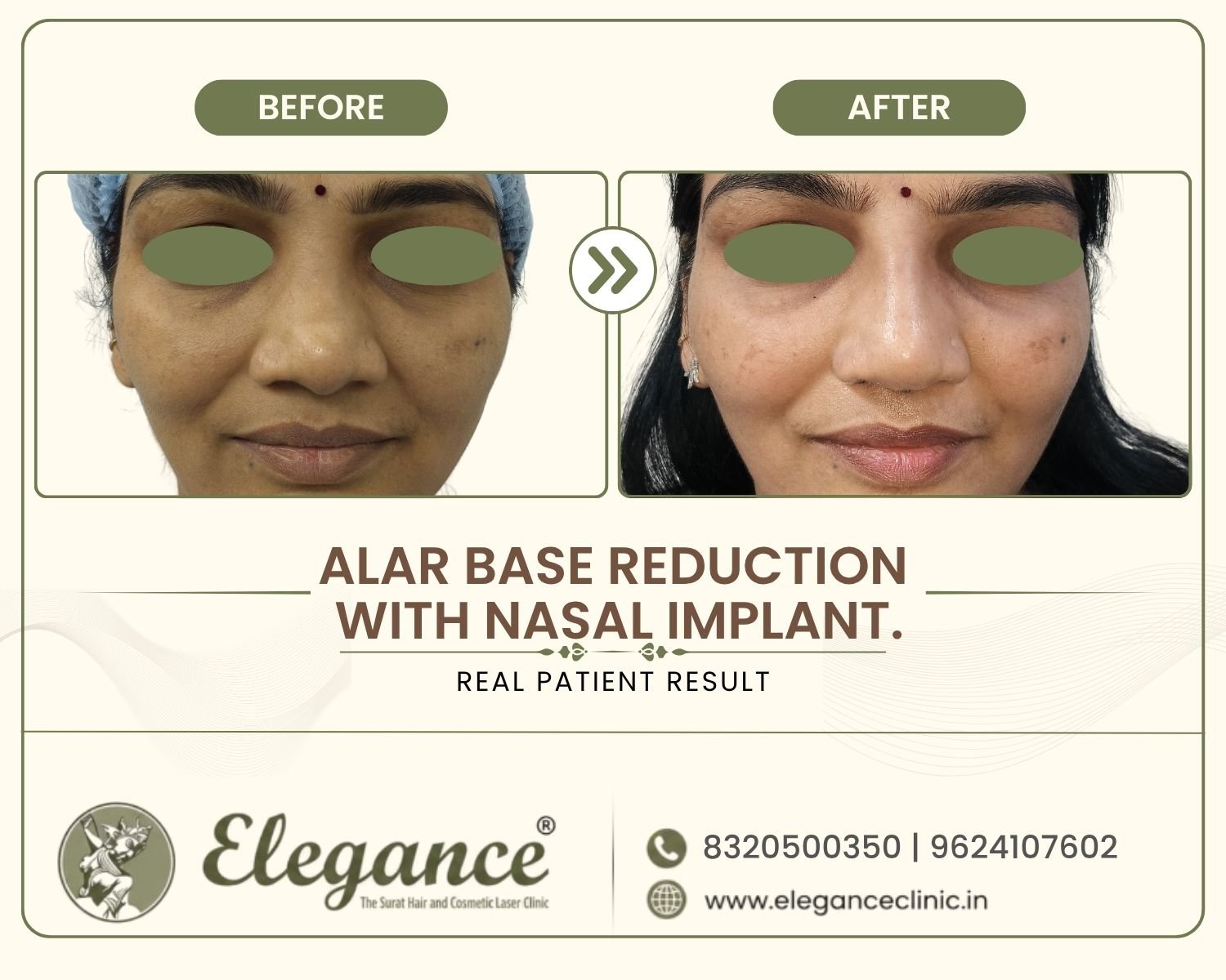 Alar-Base-Reduction-Nasal-Implant-Front-View
