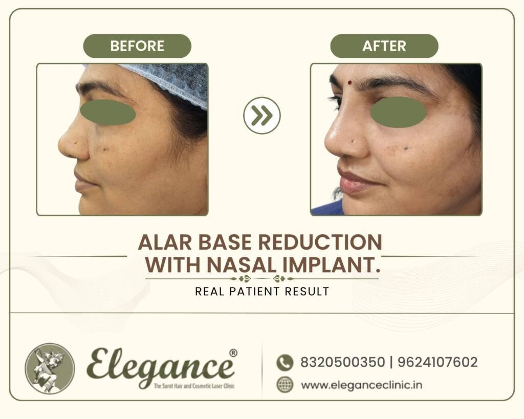 Alar-Base-Reduction-Nasal-Implant-Profile-View