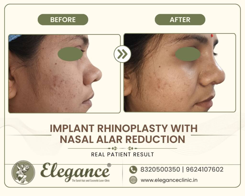 Alar-Reduction-Rhinoplasty