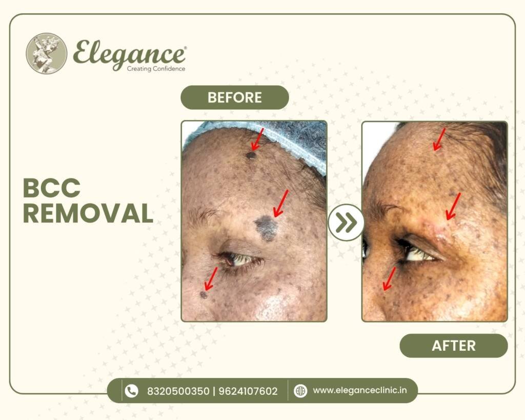 BCC-Removal