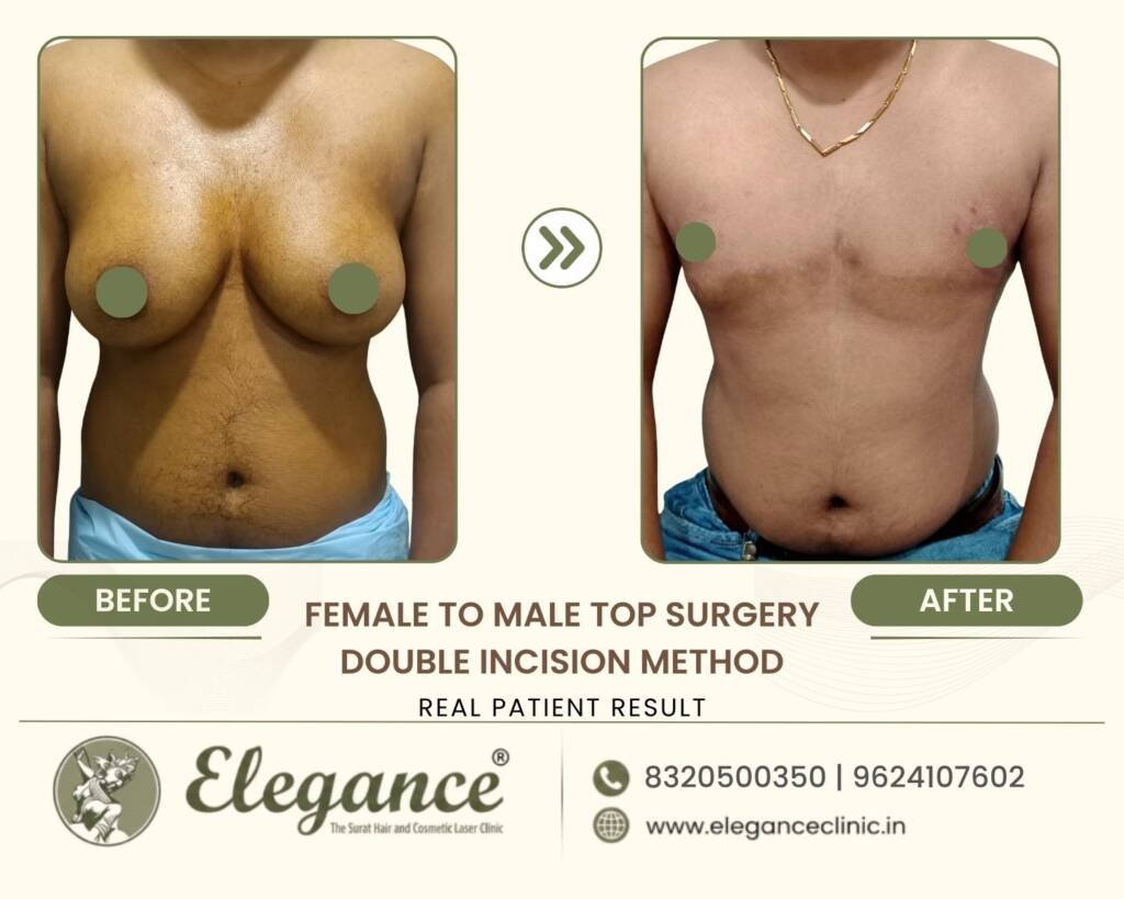 Bilateral-Double-Incision-Top-Surgery