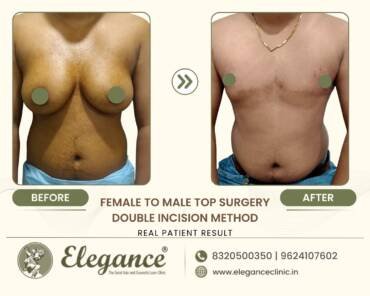 Bilateral-Double-Incision-Top-Surgery