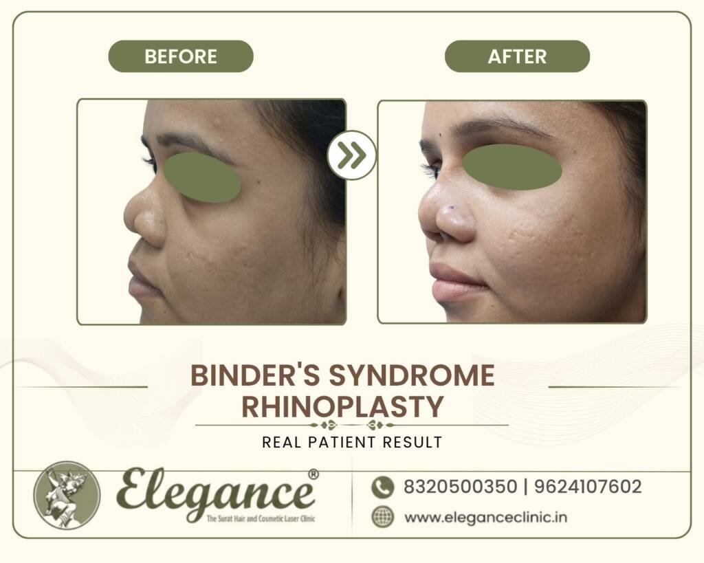 Binder-Syndrome-Nasal-Reshaping