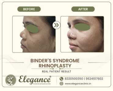 Binder-Syndrome-Nasal-Reshaping