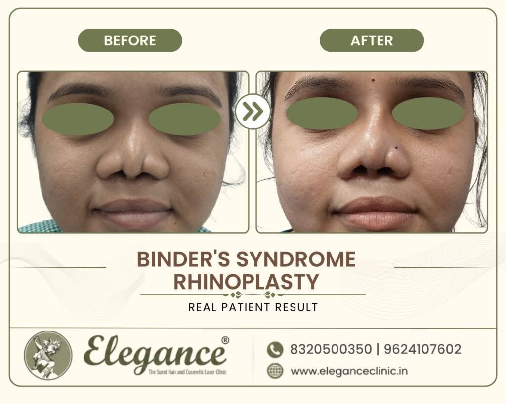 Binder-Syndrome-Nose-Correction