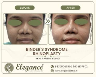 Binder-Syndrome-Nose-Correction
