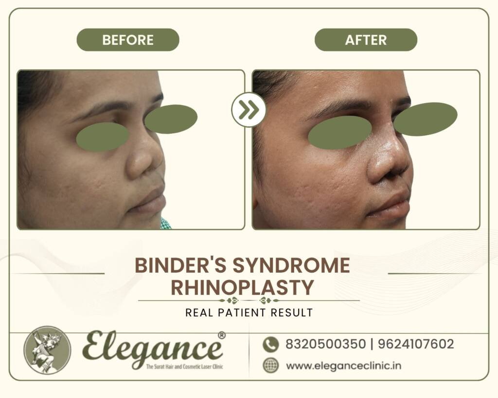 Binder-Syndrome-Profile-Correction