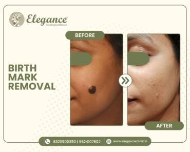 Birth Mark Removal