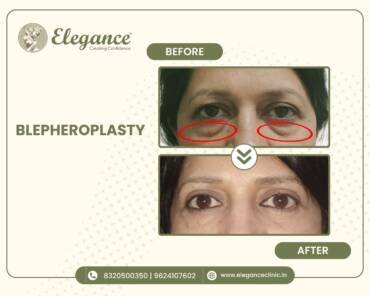 Blepharoplasty