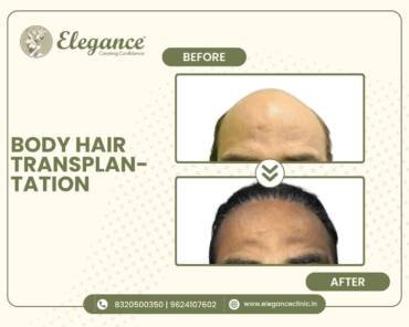 Blepharoplasty