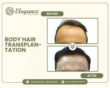 Body-Hair-Transplantation-Hairline