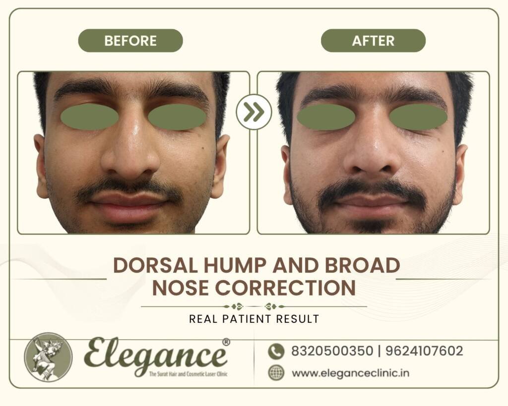 Broad-Nose-Correction