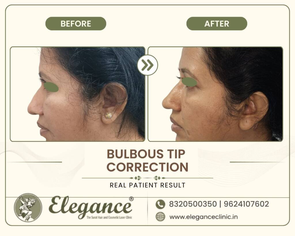 Bulbous-Nasal-Tip-Correction