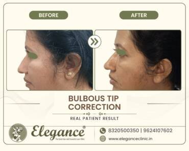 Bulbous-Nasal-Tip-Correction